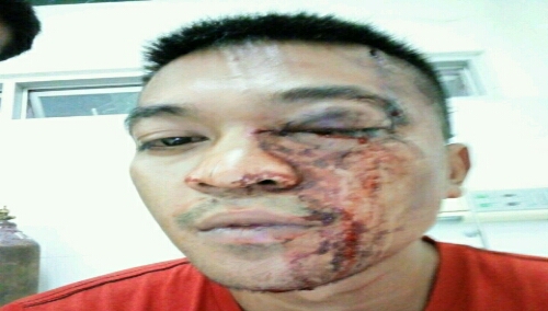 Foto : Budi Simbolon, Korban Penganiayaan Cafe Plamboyan berada di Rumah Sakit Adam Malik Medan Sumatera Utara