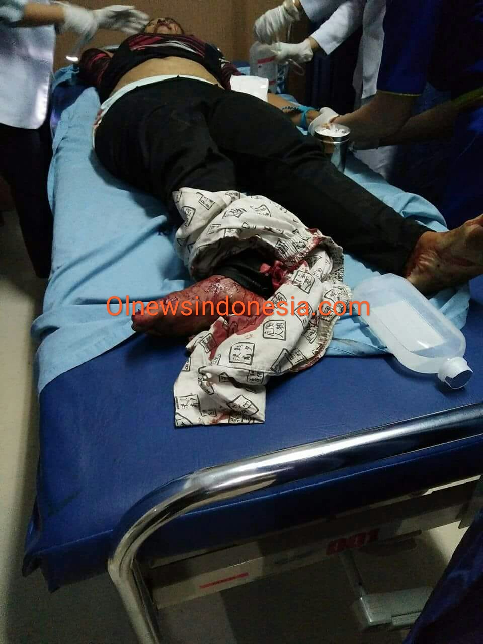 Ket foto :Salah satu guru TK yang mengalami kecelakaan bus Parawisata sabtu (09/06)
