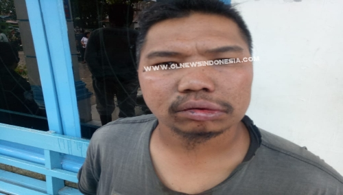 Ket foto : tampak wajah dan bibir Harja Sinuraya memar.