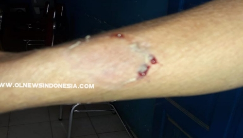 Ket foto  : bekas luka Korban(guru SD) Oleh tersangka sesama guru SD Negeri 040463 Sumbul Kabanjahe Tanah Karo